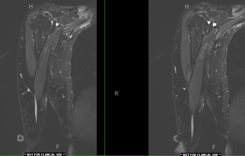 Figure 3 for case Multifocal motor neuropathy